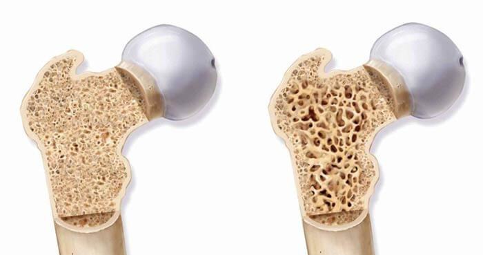 هشدار نسبت به شیوع بالای پوکی استخوان در جامعه