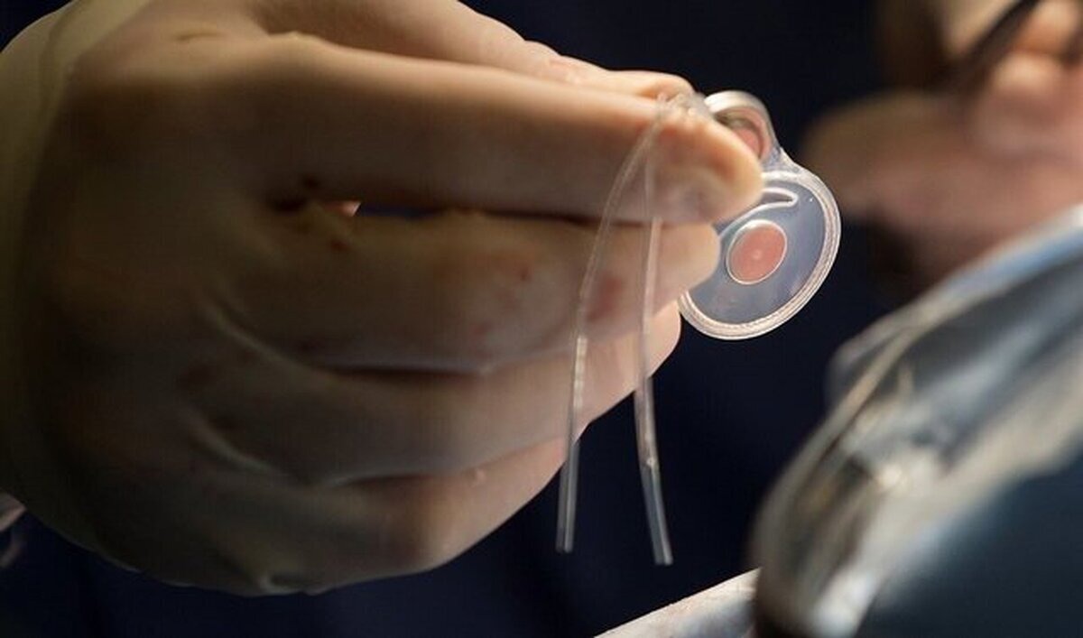 آغاز صید حلزون‌های ناقل شیستوزومیازیس در غرب اهواز