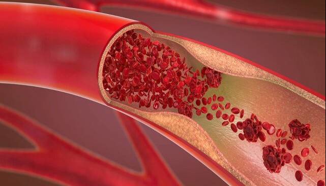 کاهش چشمگیر چربی خون با یک داروی جدید