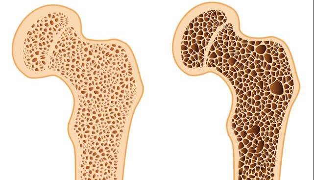 تولید مکمل کلسیم نانویی با هدف حمایت از سلامت استخوان در دوران سالمندی